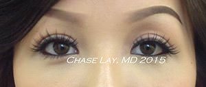 Asian Eyelid Surgery