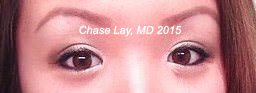 Asian Eyelid Surgery