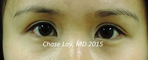 Asian Eyelid Surgery