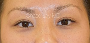 Asian Eyelid Surgery