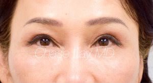 Asian Eyelid Surgery