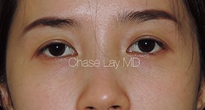 Asian Eyelid Surgery