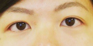 Asian Eyelid Surgery