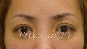 Asian Eyelid Surgery