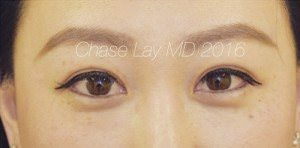 Asian Eyelid Surgery