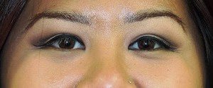 Asian Eyelid Surgery