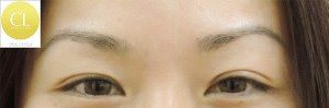 Asian Eyelid Surgery