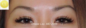 Asian Eyelid Surgery