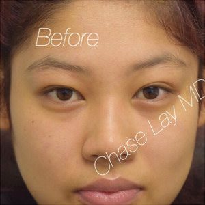 Asian Eyelid Surgery