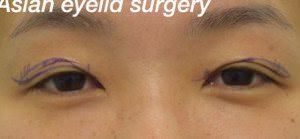 Asian Eyelid Surgery