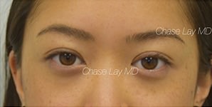 Asian Eyelid Surgery