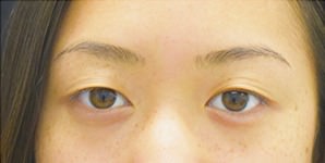 Asian Eyelid Surgery