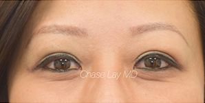 Asian Eyelid Surgery