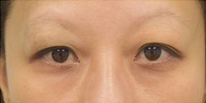 Asian Eyelid Surgery