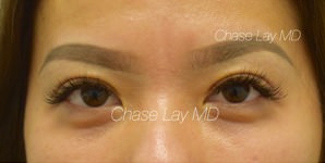 Asian Eyelid Surgery