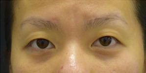 Asian Eyelid Surgery