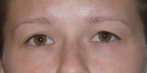 Eyelid Surgery