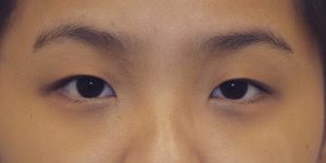 Asian Eyelid Surgery