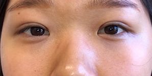 Asian Eyelid Surgery