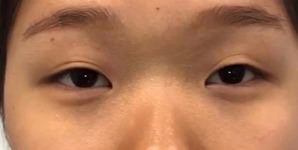 Asian Eyelid Surgery