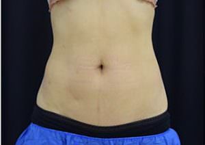 CoolSculpting Before & after Photos