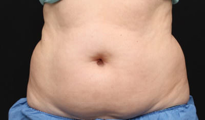 CoolSculpting