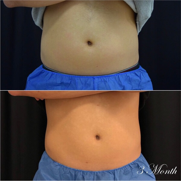 CoolSculpting Before & after Photos