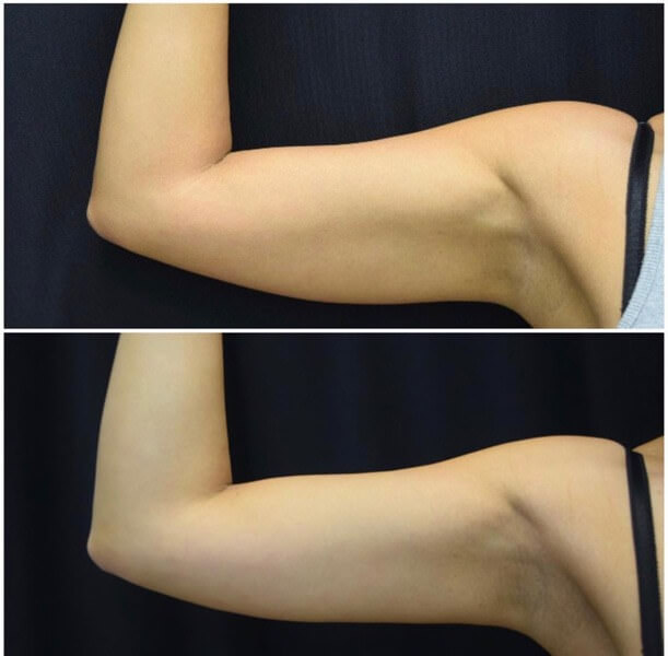 CoolSculpting Before & after Photos