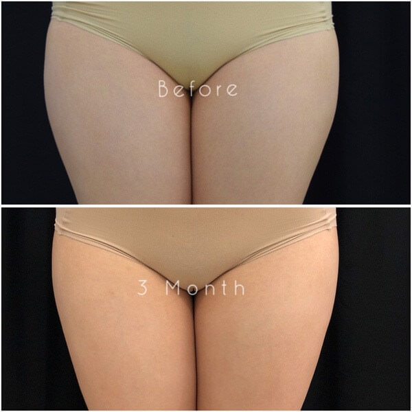 CoolSculpting Before & after Photos