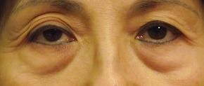 Eyelid Surgery Before & After Photos