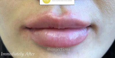 Dermal Fillers