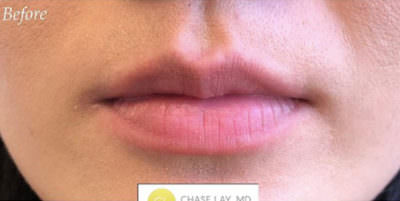 Dermal Fillers