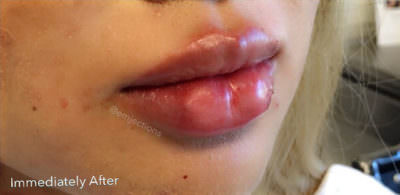 Dermal Fillers