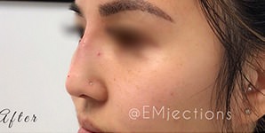 Non-Surgical Rhinoplasty Before & After Photos