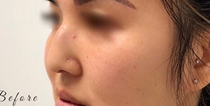 Non-Surgical Rhinoplasty Before & After Photos