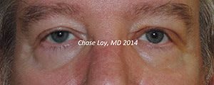 Ptosis Before & After Photos