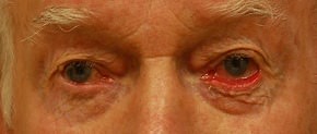 Reconstruction & Skin Cancer Before & After Photos