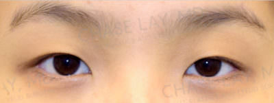 Asian Eyelid Surgery