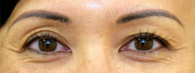 Asian Eyelid Surgery