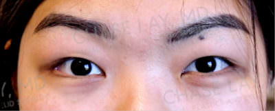 Asian Eyelid Surgery