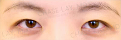 Asian Eyelid Surgery