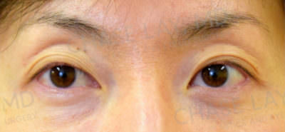 Asian Eyelid Surgery