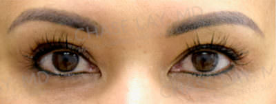 Asian Eyelid Surgery