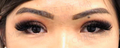 Asian Eyelid Surgery