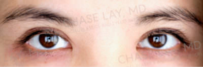 Asian Eyelid Surgery