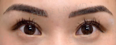 Asian Eyelid Surgery