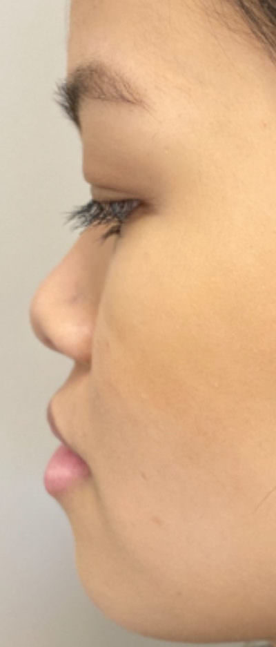 Non-Surgical Rhinoplasty