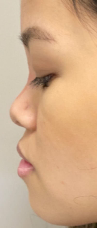 Non-Surgical Rhinoplasty