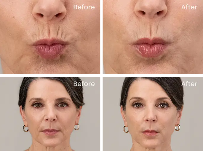 Photo of patients before and after Daxxify treatment