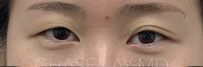 Asian Eyelid Surgery